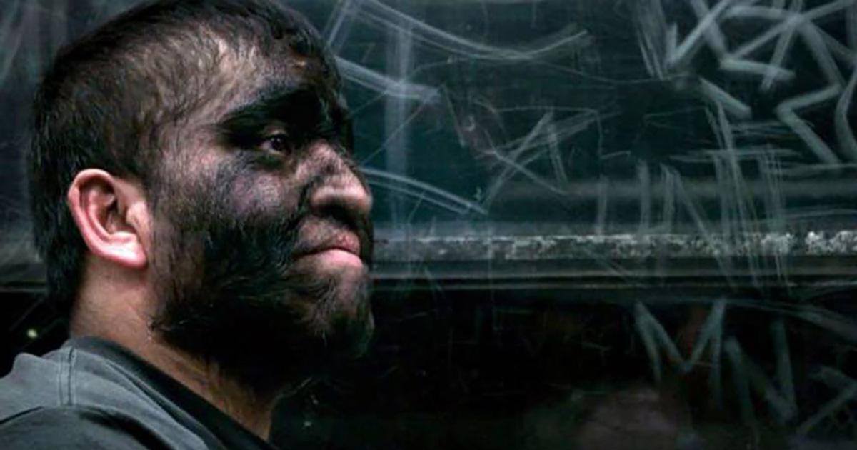 Chuy, l'homme « loup-garou », aimerait être heureux