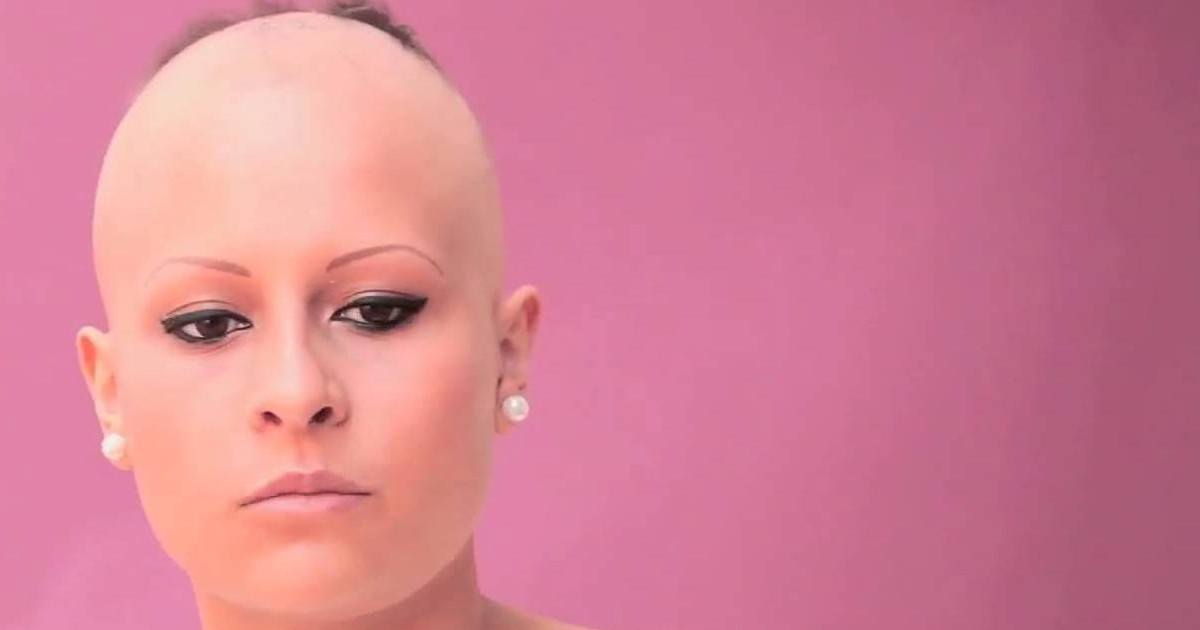 Elle capture la beauté des femmes souffrant d'alopécie