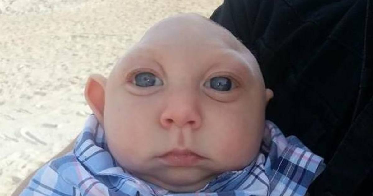 Jaxon Le Bebe Ne Sans Crane Fete Ses Un An Et Emeut Le Web Jaxon Le Bebe Ne Sans Crane Fete Ses Un An Et Emeut Le Web