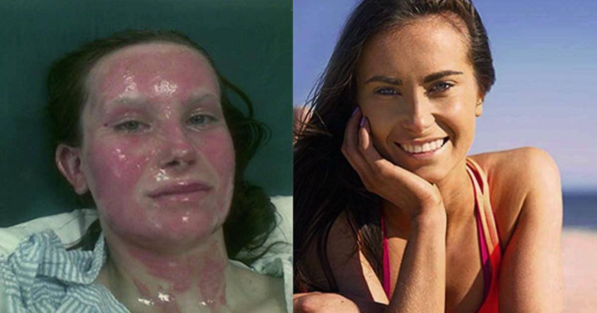 Terriblement brûlée, cette jeune femme est devenu sublime grâce au sport