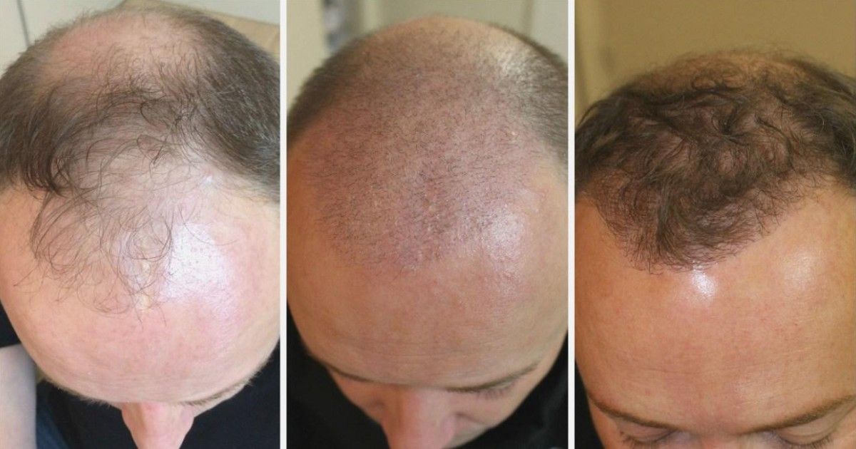 Comment se fait la repousse après une greffe de cheveux ?