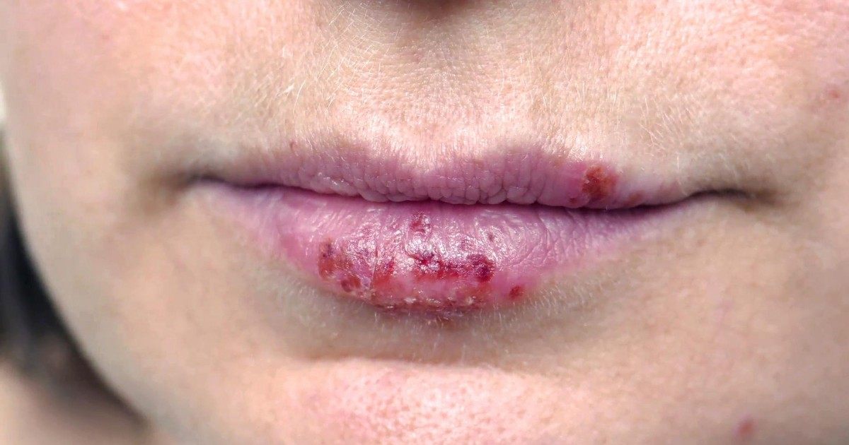 La solution pour se débarrasser de l'herpès du jour au lendemain facilement